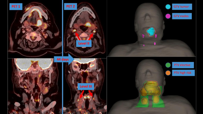A second-look PET/CT scan revealed two newly involved lymph nodes in level II bilaterally and two in level III bilaterally