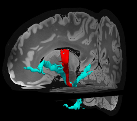Edlow 7-tesla MRI of the ex vivo human brain at 100 micron resolution, rendered with Freesurfer