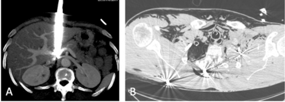 Two cases that underline the importance of CT examinations in ballistic assessment of trauma