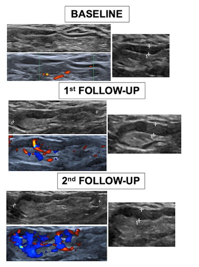 Comparative ultrasound images from one volunteer between baseline and the first and second follow-ups shows a significant gradual increment of maximum diameter, cortex, Bedi’s classification, and Doppler scale degree