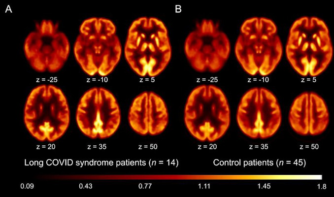 Transaxial sections F-18 FDG PET scans in patients with long COVID-19 and control patients