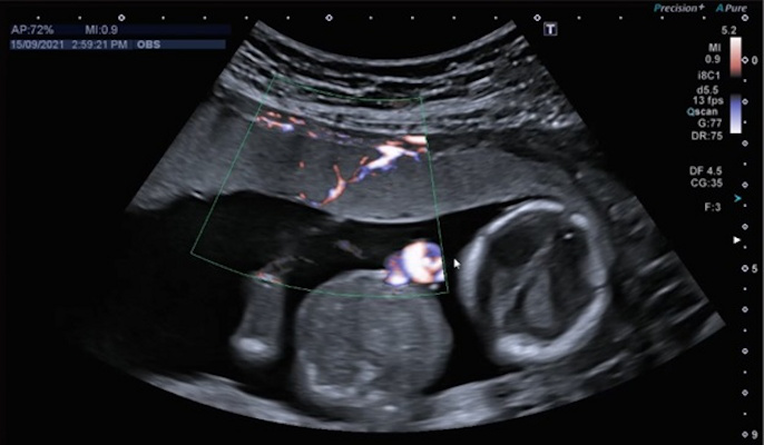 Ultrasound image of shared placenta with a blood vessel linking the two circulations shown in color using low-flow Doppler