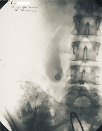 Oral cholecystogram from 1934 showing opacified gallbladder