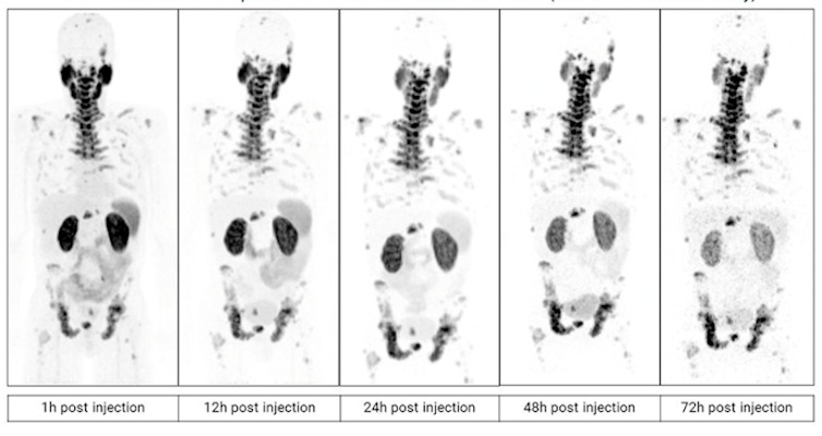 PET scans in a patient with metastatic castration-resistant prostate cancer imaged over multiple time points between one and 72 hours after administration of Cu-64 SAR-bisPSMA