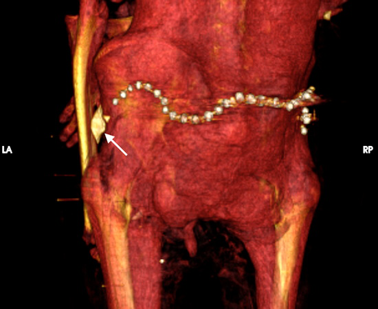 3D CT image of the surface of the lower back of mummy Amenhotep I shows a beaded metallic girdle at the back of the pelvic region and a faience amulet in the shape of a snail shell in the left hip region