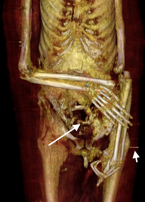 3D frontal CT of the lower torso and upper limbs of the mummy of Amenhotep I