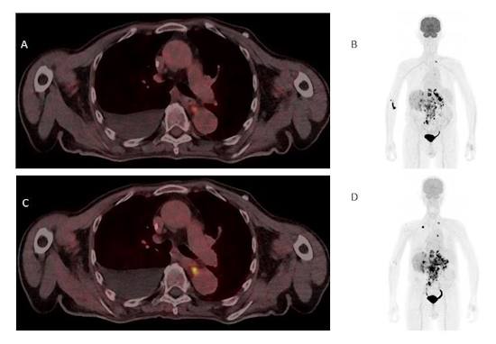 Single-tracer PET/CT with F-18 FDG showing fused images in the axial plane of a primary tumor at the gastroesophageal junction with a metastasis in the left adrenal gland and liver metastases