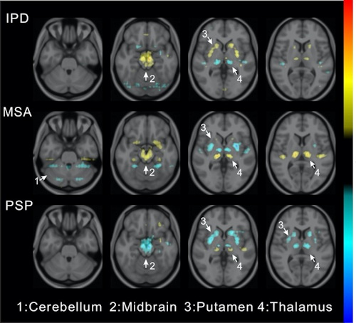 Visualization of average saliency maps of patients with idiopathic Parkinson