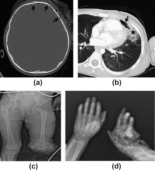 CT and radiography images of a 4-year-old girl with primary blast injury