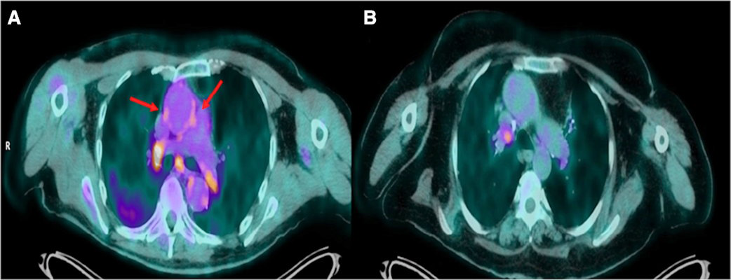 Transaxial views of fused F-18 FDG PET/CT images of two patients with COVID-19