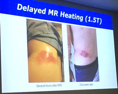 This patient suffered a thermal burn due to delayed MR heating after a 1.5-tesla scan