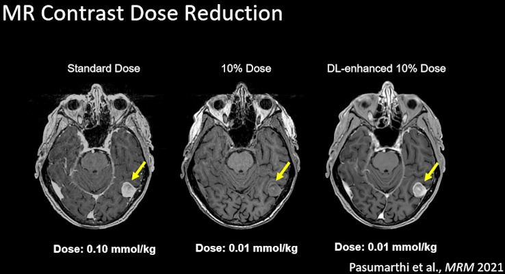 A 90% contrast dose reduction is feasible