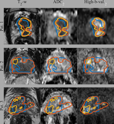 Gross tumor volume segmentations overlaid on the input image sequences for three patients from the test set