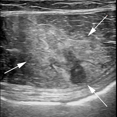 Ultrasound of acute rectus abdominus injury