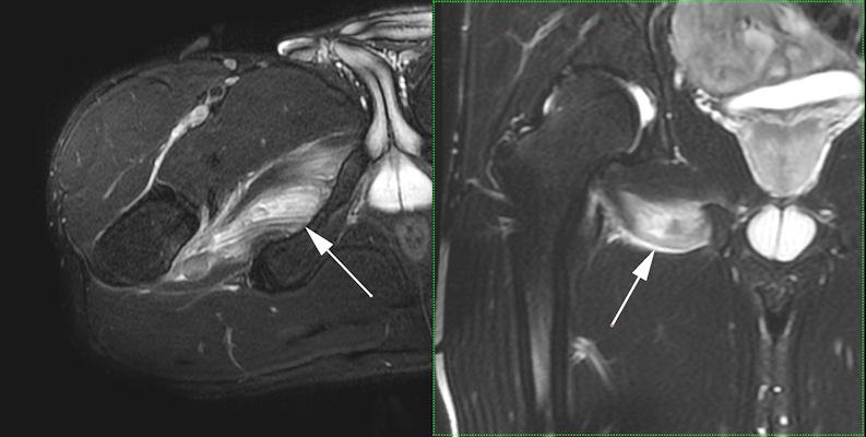 MRI of acute obturator externus injury