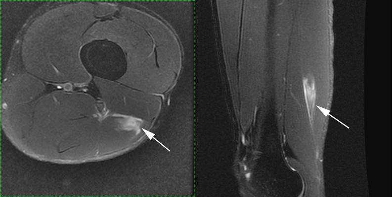 MRI of acute biceps femoris injury