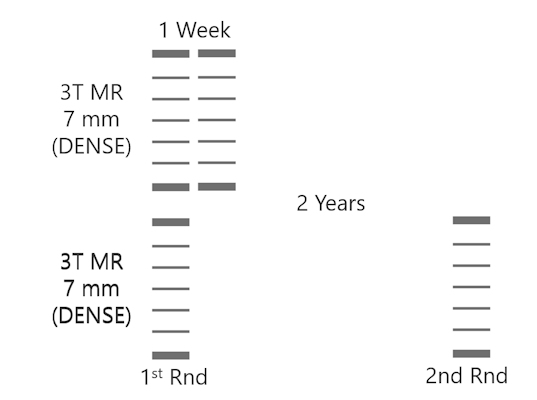 Sieve model of breast cancer screening for the two-year interval of the second round of the 3T MRI DENSE trial compared with a hypothetical model with only one week between screens