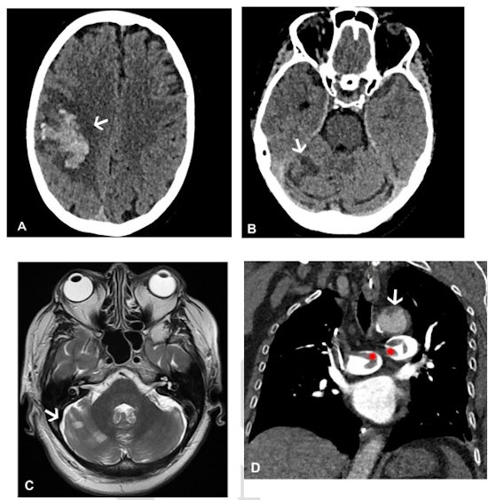 Images in a 64-year-old woman who presented with confusion and collapse and was diagnosed with intracranial hemorrhage associated with cerebral venous sinus thrombosis secondary to VITT