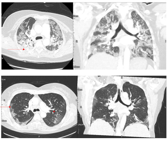 Axial and coronal CT images on lung window in a 33-year-old woman with delta SARS-CoV-2 pneumonia without critical care admission