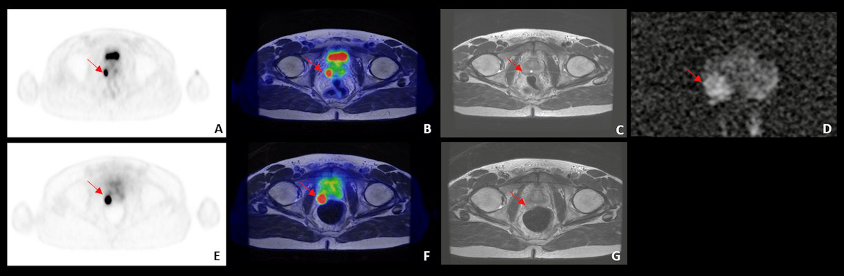 Example of an intraprostatic concordant finding in a 53-year-old patient who underwent dual-tracer PET/MRI for prostate cancer staging