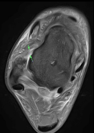 Axial fat-suppressed proton density 3-tesla MRI of the right ankle demonstrates a grade 1/2 tear of the anterior talofibular ligament