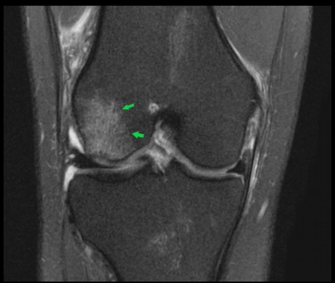 Coronal fat-saturated proton density 3 tesla MRI of the right knee shows an acute pivot shift injury with an acute lateral condylar bone contusion