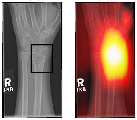 Image shows area with fracture not easily picked up by inexperienced radiographers