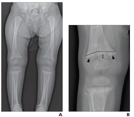 a 21 month old girl with rickets and low vitamin D level 
