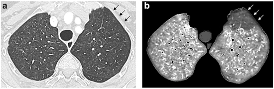 Dual-energy CT angiographic examination obtained in an 85 year old female with limited cutaneous systemic sclerosis diagnosed 18 years earlier
