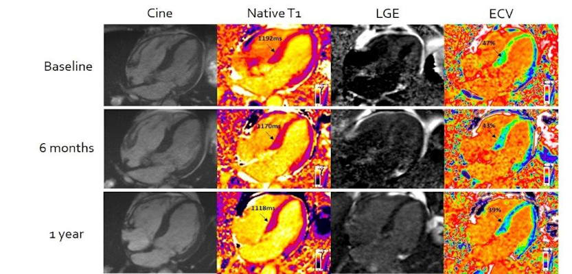 Improvement in cardiac amyloidosis demonstrated by cardiovascular MR extracellular volume mapping for amyloid