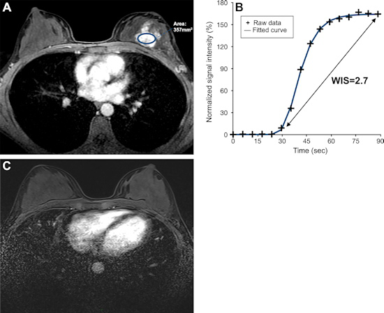 Ultrafast breast DCE MRI scans in a 47 year old woman who underwent neoadjuvant chemotherapy for hormone receptor negative and HER2 positive cancer