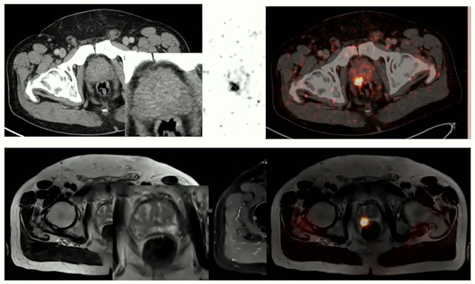 PET/MRI prostate images