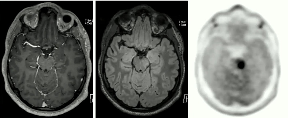 PET MRI neuro oncology images