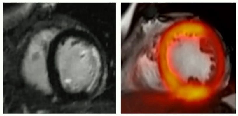 PET/MRI images of myocardial infarction