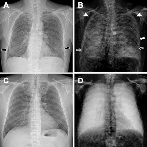 Conventional attenuation-based chest x-rays