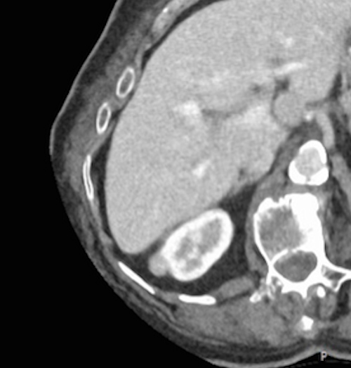 When an 81-year-old patient underwent CT for elevated liver markers