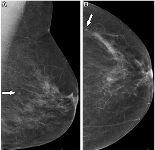 Mammograms in a 50 year old woman show a 3 mm mass that was not recalled by the radiologist but was recalled by the radiographer