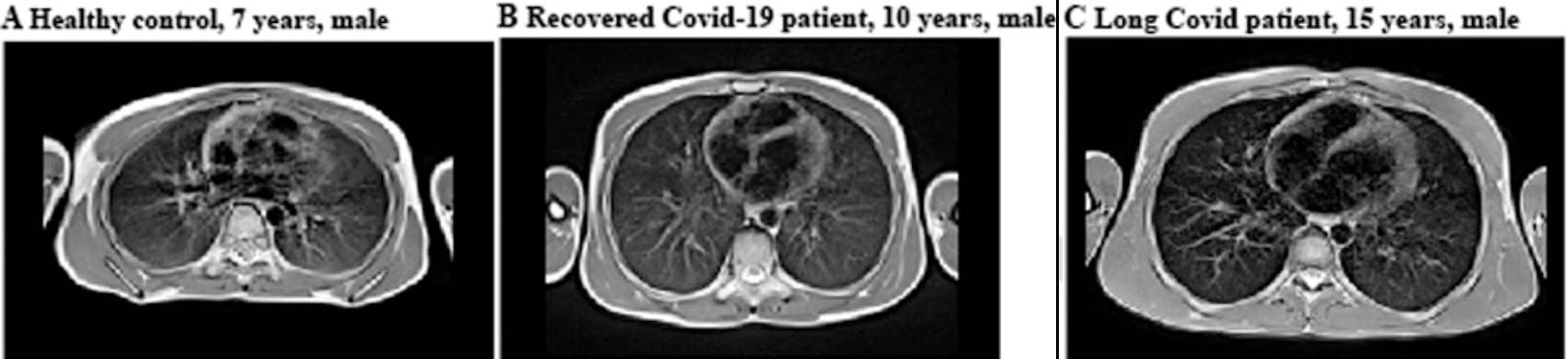 Images acquired in a healthy control as well as a participant recovered from COVID and a participant with long COVID