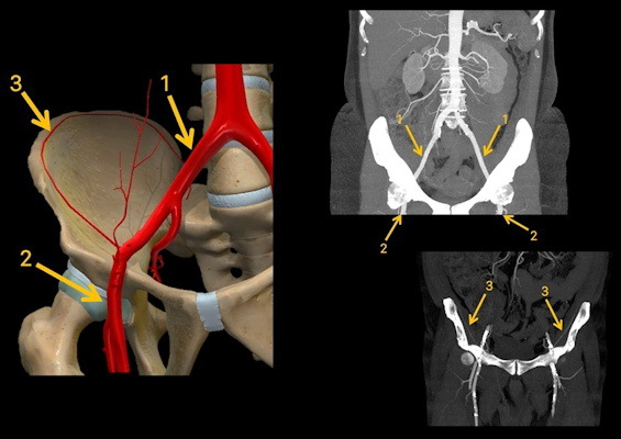 Anatomy of external iliac artery