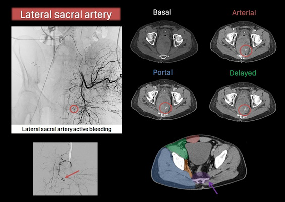Active bleeding in the lateral sacral artery
