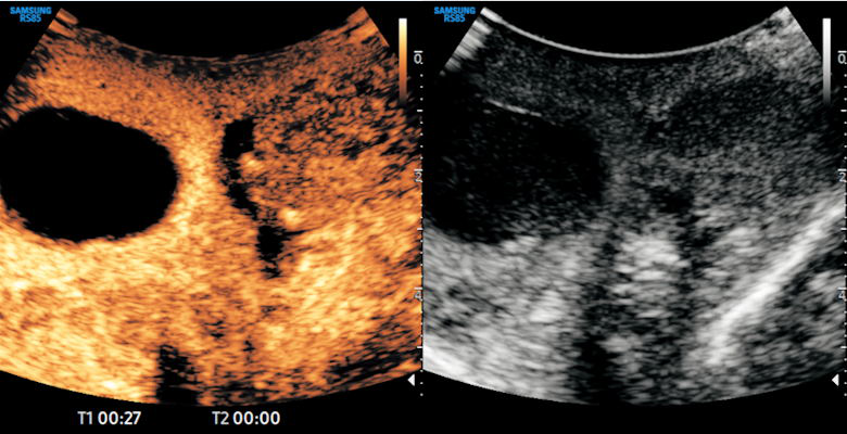 Contrast-enhanced ultrasound demonstrates testicular infarction in a case of spermatic cord torsion