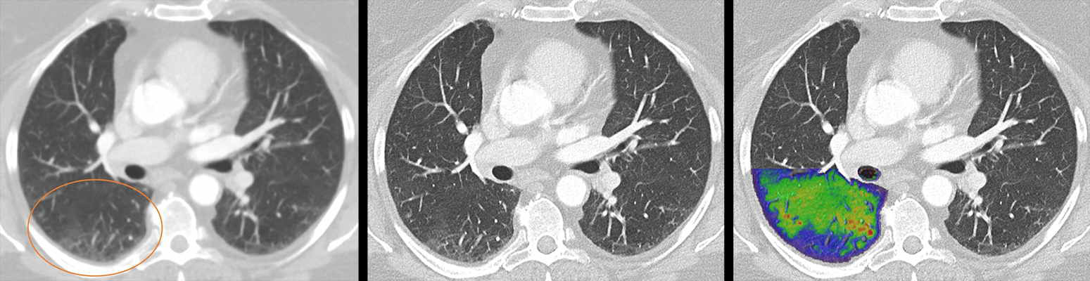 Lung images of a post-COVID patient with photon-counting CT