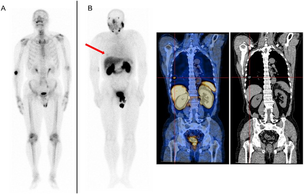 A 66-year-old patient with biochemical recurrence of prostate cancer