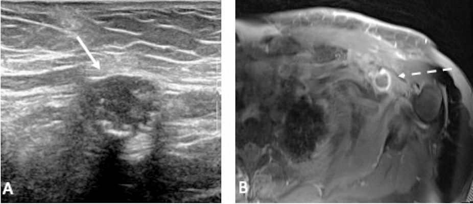 Left axillary ultrasound shows a round hypoechoic mass