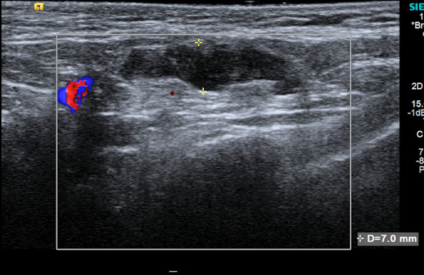 A 37 year old woman with bilateral subpectoral implants presented to breast clinic at the Royal Free Hospital with a two week history of palpable left axillary lump