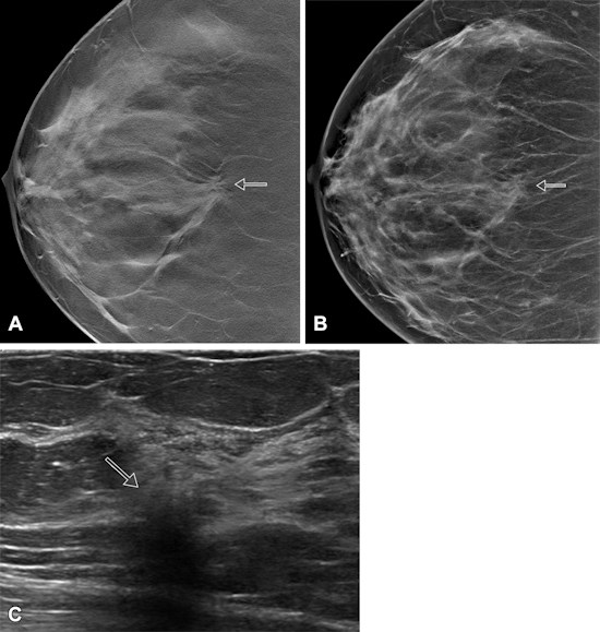 Images show screen-detected invasive breast cancer in dense breast tissue in a 65 year old woman