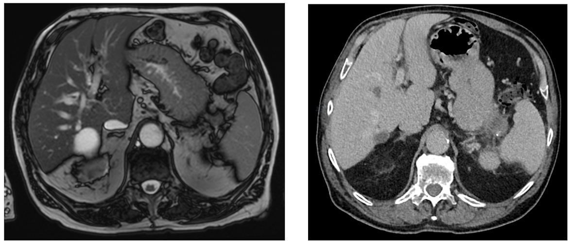 Two scans taken six months apart. Missed pancreatic tumor (stage IVB). Imaging was inadequate to exclude the lesion. The lesion in the tip of the pancreatic tail was likely present on the MRI for renal cancer restaging six months prior but could not be called, even in retrospec