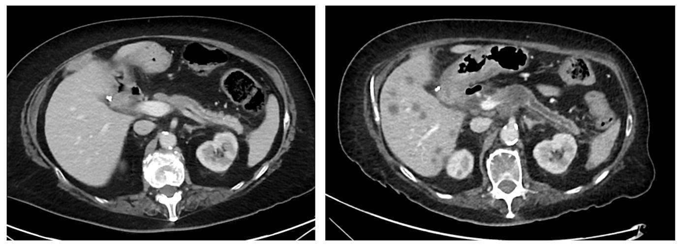 Two scans taken six months apart. Missed pancreatic tumor (stage IIIA), with the lesion being visible on review. Low attenuation area proximal body and minimal pancreatic duct dilatation distally were not reported.