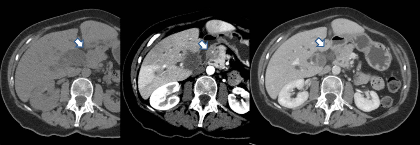 The tumor is not visible on either the precontrast scan or in the portal venous phase. It is only visible as a hypovascular mass on the later arterial phase. This technique is important when looking for pancreatic cancer