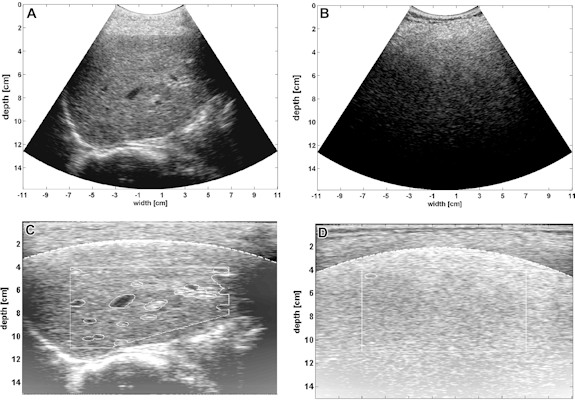 Calibrated ultrasound software shows a normal liver